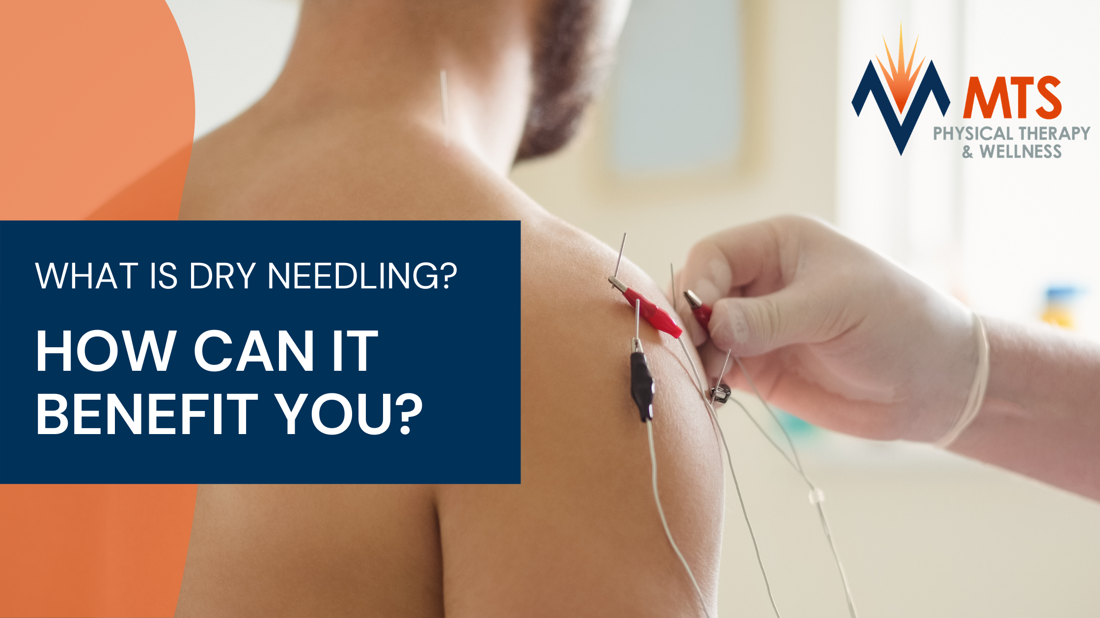 What is Dry Needling & How Can It Benefit You?